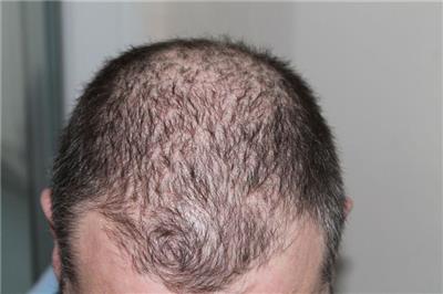 如何预防脱发和头皮屑问题